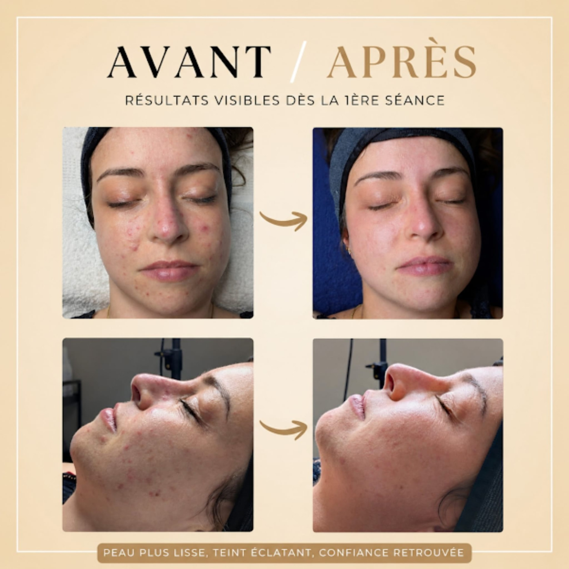 Avant / après soin du visage à l'institut Âméa : peau plus lisse et teint éclatant dès la première séance